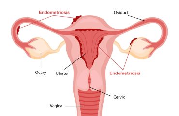 Endometriosis
