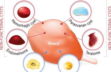 Laparoscopía en Quistes de Ovario