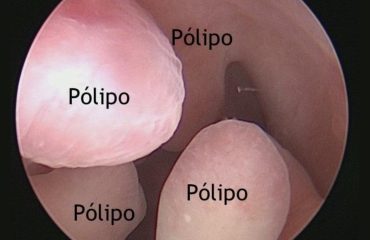 Pólipos Uterinos