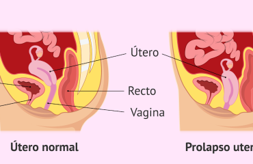 Copyright Reproducción Asistida | https://www.reproduccionasistida.org/prolapso-uterino/