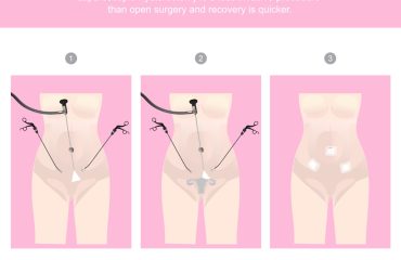 Sangrado Uterino Anormal (SUA)